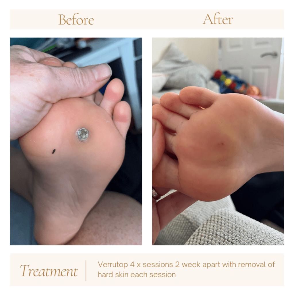 Stubborn Verrucae – hello verrutop! 1 Neutral Before and After Instagram Post 1024x1024 1